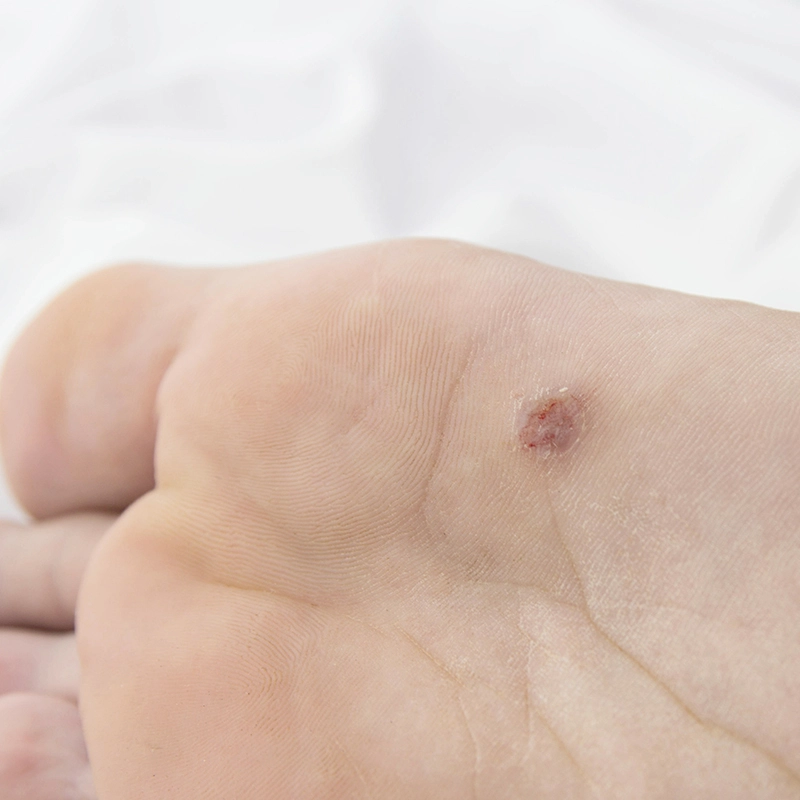 Are Plantar Warts Contagious