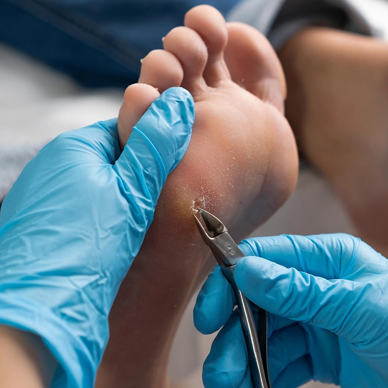 How Are Plantar Warts Treated