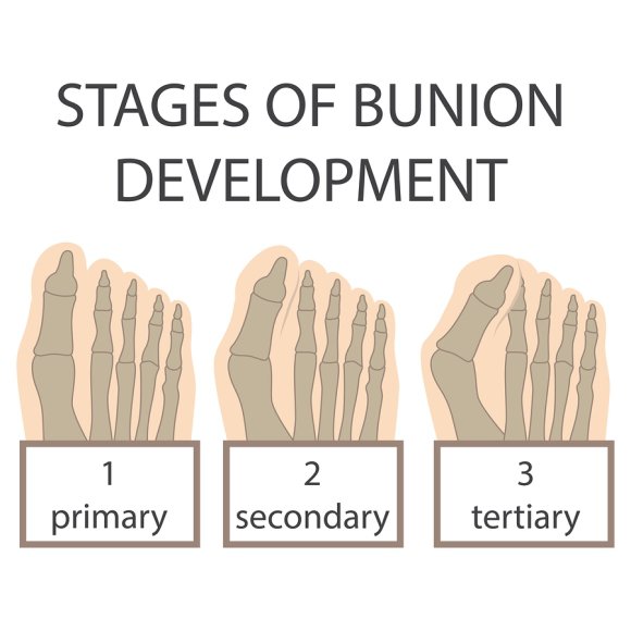 stages of bunion development