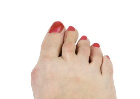 bunion foot causes