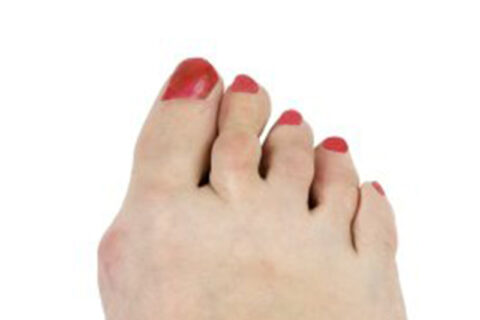 bunion foot causes