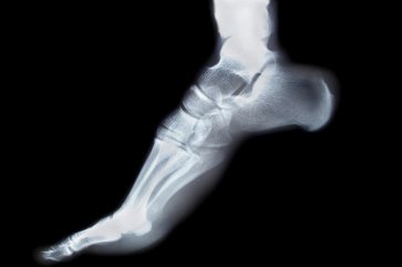 foot x-ray