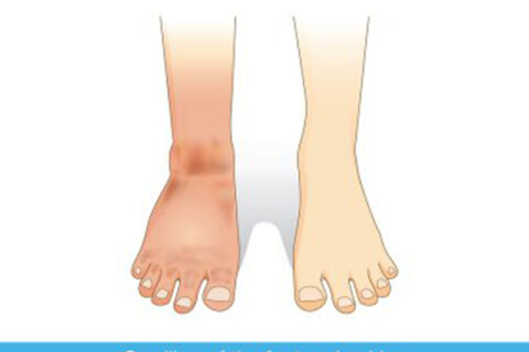 Swelling foot and normal foot