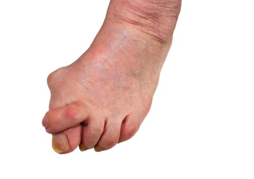 Bunion Surgery