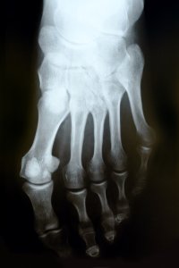 X-ray image of a foot