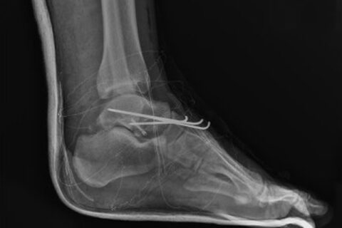 X-ray image of leg