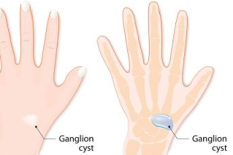 ganglion cyst treatment
