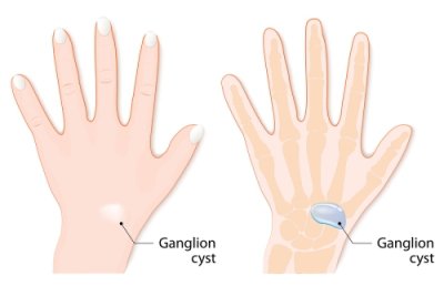 Ganglion Cyst Aspiration