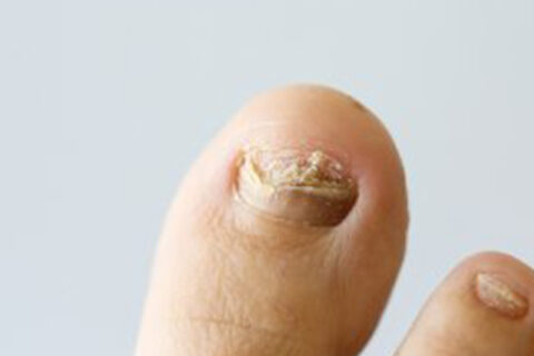 toe mail damage