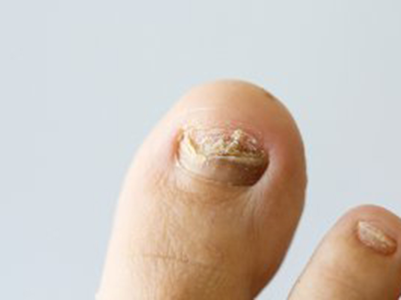 Fungal Toenail Infections Spread, Prevention, and Treatment | Podiatrist in  Walnut Creek