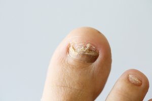 toe mail damage